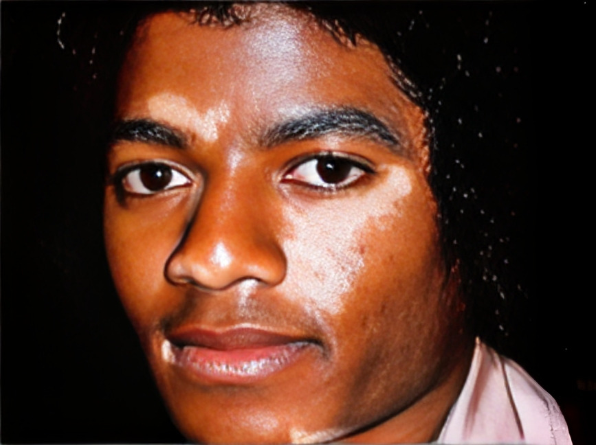 Did Michael Jackson Have Vitiligo - Beauty Style Blog